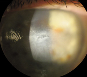 Acuity Laser Eye epi defect