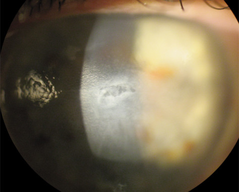 Acuity Laser Eye epi defect