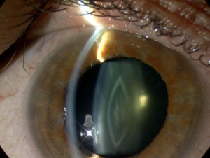 Cataract yellow