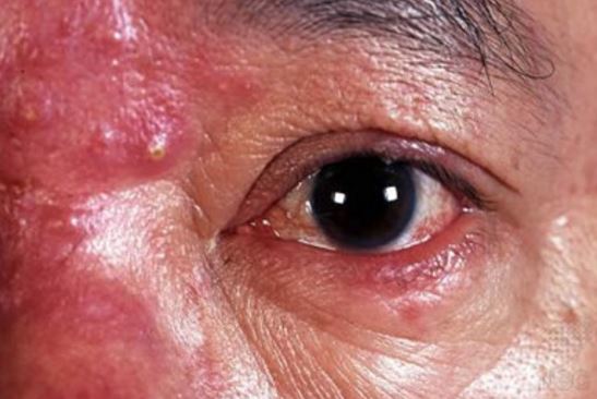 Ocular-rosacea-can-cause-pimple-like-bumps-around-the-eye