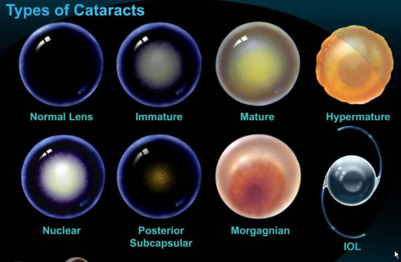 types-of-cateracts